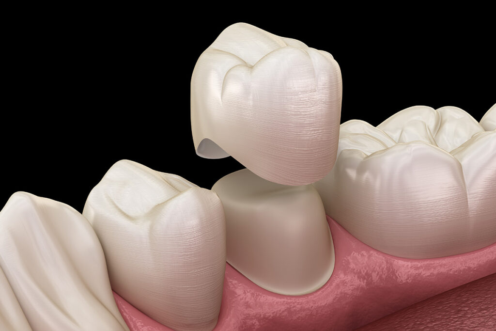 Dental crown diagram