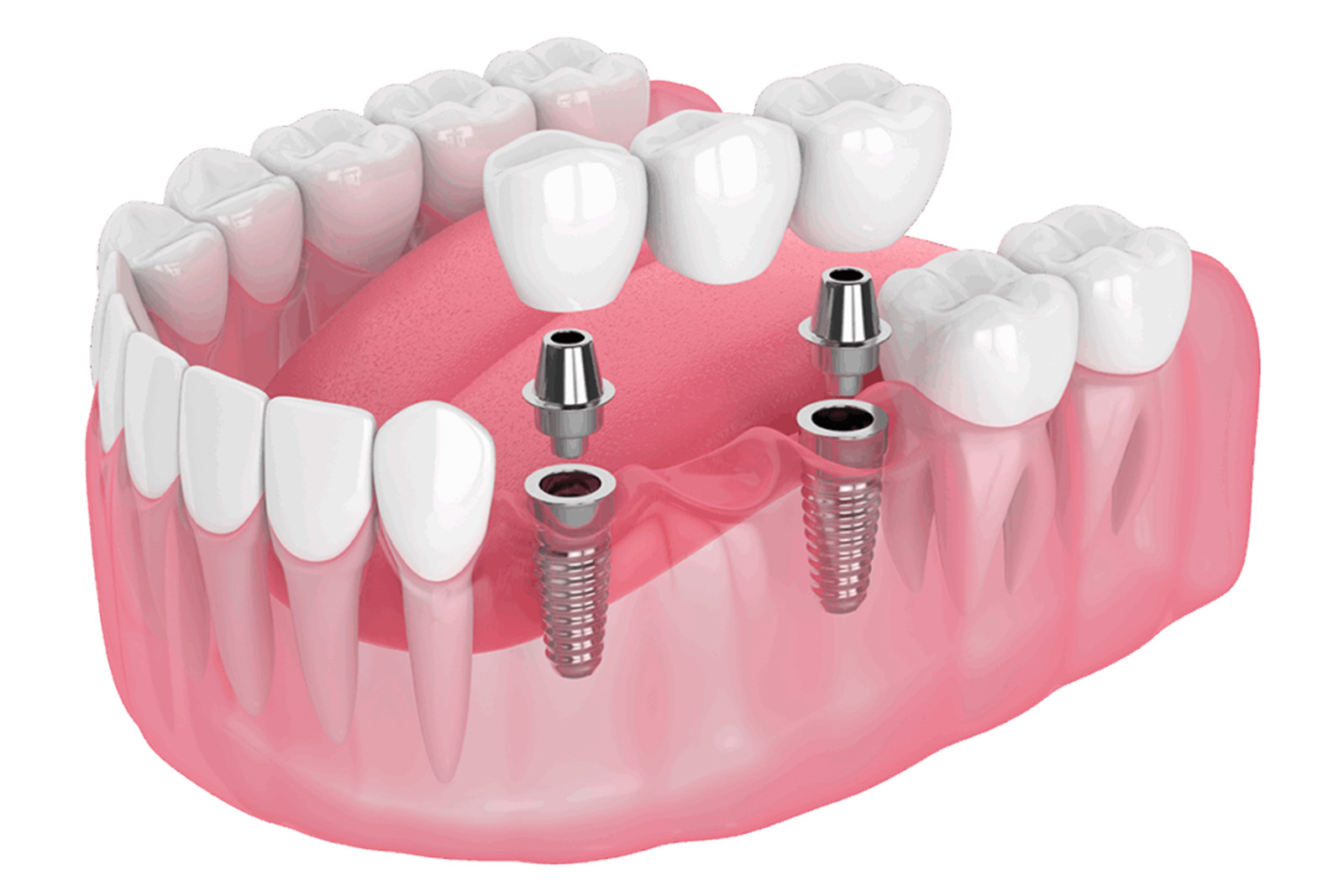 Dental implant bridge